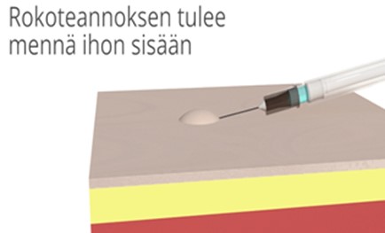 En ljus upphöjning i huden bildas som ett tecken på en lyckad vaccination.