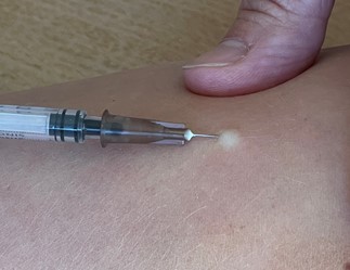 En ljus upphöjning i huden bildas som ett tecken på en lyckad vaccination