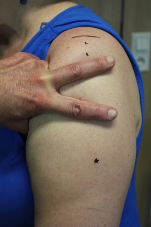 Rätt injiceringsställe.