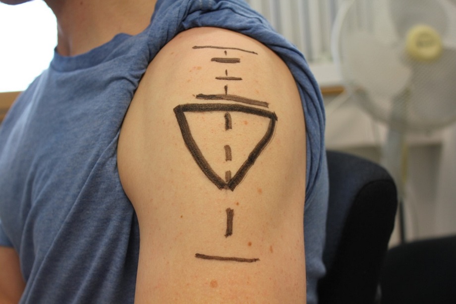 Rätt injiseringsställe.