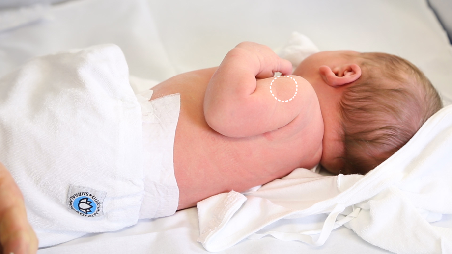 BCG-rokotteen pistopaikka lapsen olkavarressa